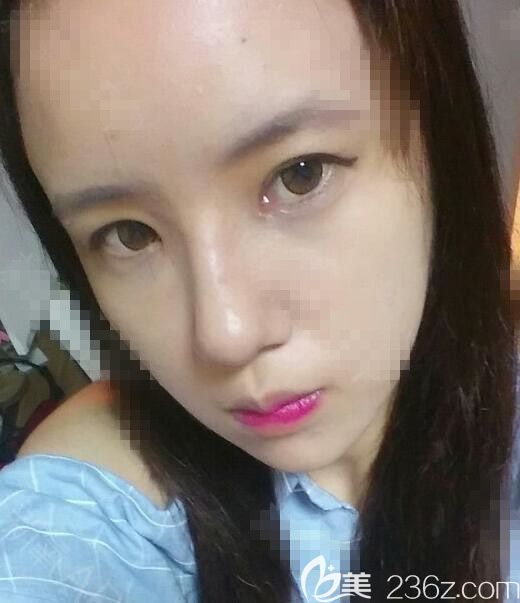 隆鼻术后2周 隆鼻术后2周