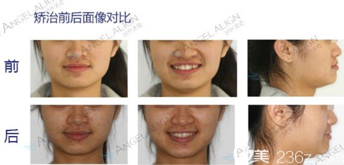 深圳拜尔口腔成人牙齿拥挤矫正后脸型变化图 深圳拜尔口腔成人牙齿拥挤矫正后脸型变化图