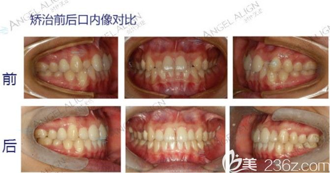 牙齿拥挤做完牙齿矫正后口内对比效果 牙齿拥挤做完牙齿矫正后口内对比效果