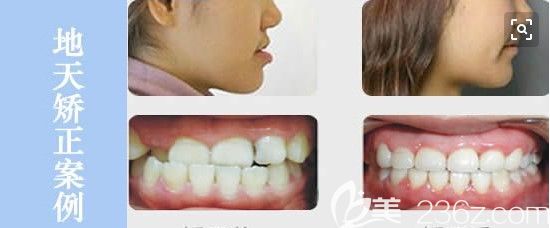 深圳拜尔口腔青少年地包天矫正脸型变化及前后对比照 深圳拜尔口腔青少年地包天矫正脸型变化及前后对比照
