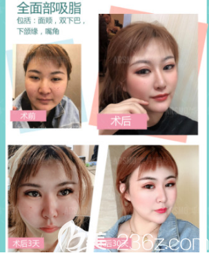 北京华韩余恩旭面部吸脂案例 北京华韩余恩旭面部吸脂案例