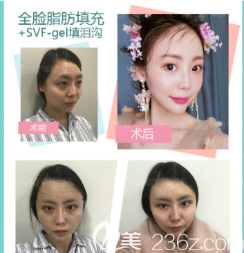 北京华韩谢立宁面部脂肪填充案例 北京华韩谢立宁面部脂肪填充案例