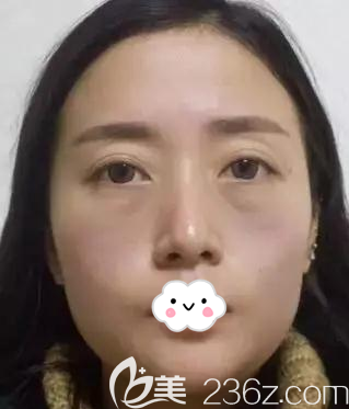 做面部脂肪填充术前素颜照片 做面部脂肪填充术前素颜照片