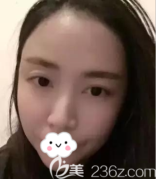 <!--<i data=20240703-sp></i>-->面填术后即刻照片 <!--<i data=20240703-sp></i>-->面填术后即刻照片