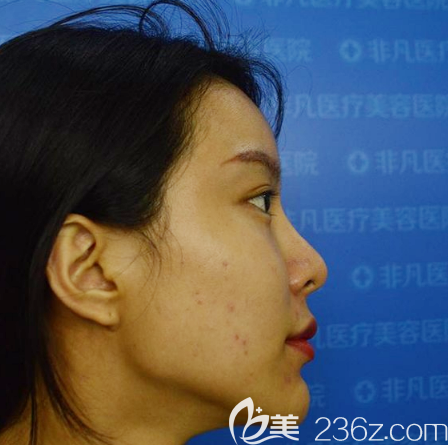 深圳非凡医疗美容医院梅够明术前照片1