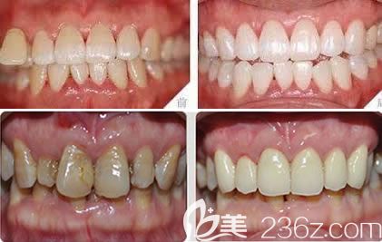 医院口腔科黄菁牙齿美白案例