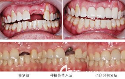黄菁种植牙案例