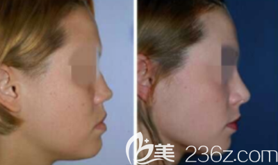 隆鼻手术案例 隆鼻手术案例