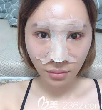 韩国POP整形医院鼻综合隆鼻手术真实过程 韩国POP整形医院鼻综合隆鼻手术真实过程