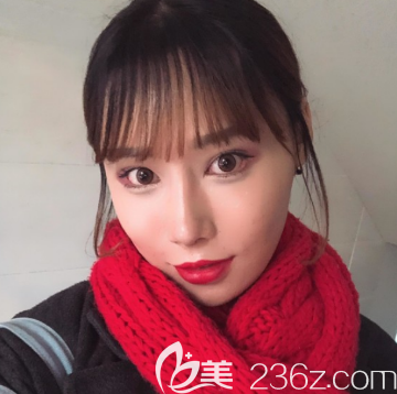 韩国POP整形医院鼻综合隆鼻术后2周恢复效果图 韩国POP整形医院鼻综合隆鼻术后2周恢复效果图