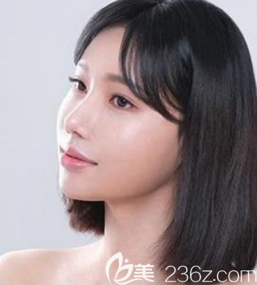 花3W多价格找韩国鼻子修复口碑好的韩国首尔POP整形医院做鼻综合隆鼻恢复过程图