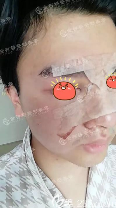 <!--<i data=20240703-sp></i>-->陈树科隆鼻案例即刻效果 <!--<i data=20240703-sp></i>-->陈树科隆鼻案例即刻效果