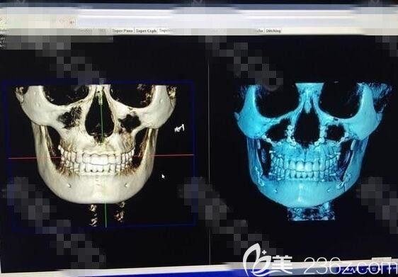 轮廓熟手ct