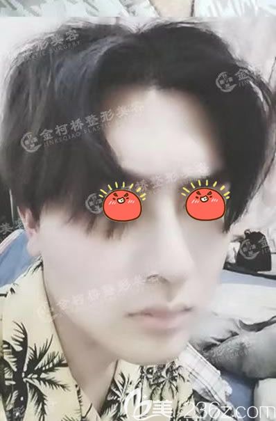 <!--<i data=20240703-sp></i>-->医院自体软骨隆鼻案例 <!--<i data=20240703-sp></i>-->医院自体软骨隆鼻案例