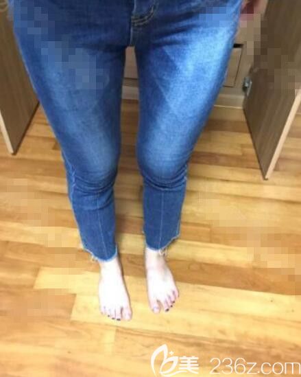 韩国劳波尔朴厚奭大腿吸脂真人案例 韩国劳波尔朴厚奭大腿吸脂真人案例