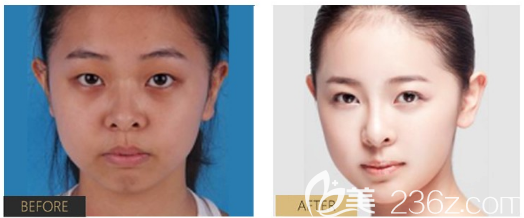 福田庆三做的鼻综合隆鼻子案例对比图片