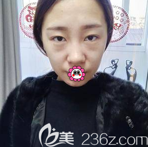 在北京画美做眼综合前样子 在北京画美做眼综合前样子