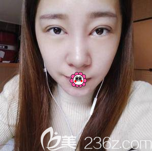 赵宏伟医生给我做眼综合第7天<span style= 赵宏伟医生给我做眼综合第7天<span style=