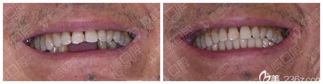 案例效果来证明<!--<i data=20240703-sp></i>-->臻威口腔好不好 案例效果来证明<!--<i data=20240703-sp></i>-->臻威口腔好不好