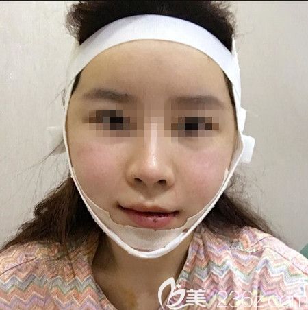 韩国拉菲安做颧骨缩小术+长曲线下颌角手术后1天