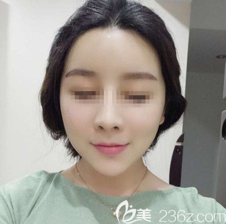 韩国拉菲安做颧骨缩小术+长曲线下颌角手术后4个月改善了我的颧骨左右不对称