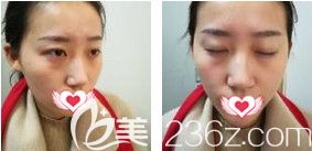 在石家庄天宏做双眼皮术前是无神单眼皮 在石家庄天宏做双眼皮术前是无神单眼皮