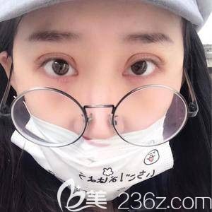 天宏整形主任孙苏宁为我做双眼皮术后5天微肿 天宏整形主任孙苏宁为我做双眼皮术后5天微肿