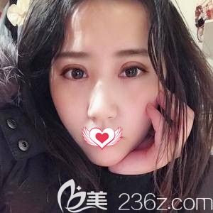 孙苏宁主任为我做双眼皮术后12天慢慢消肿 孙苏宁主任为我做双眼皮术后12天慢慢消肿