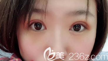 济南宝琳娜做双眼皮真不错，我在济南宝琳娜做了全切后恢复的挺快的