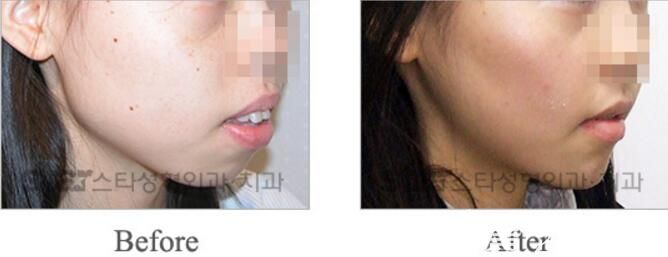 韩国明星star整形外科突嘴矫正案例 韩国明星star整形外科突嘴矫正案例