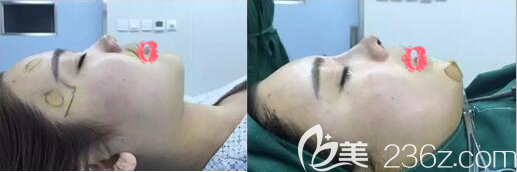 隆鼻+面部填充术后即刻对比效果 隆鼻+面部填充术后即刻对比效果