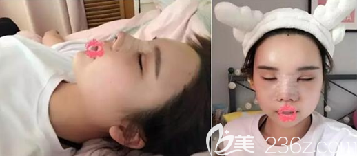 <!--<i data=20240703-sp></i>-->隆鼻术后5天正脸侧脸效果 <!--<i data=20240703-sp></i>-->隆鼻术后5天正脸侧脸效果