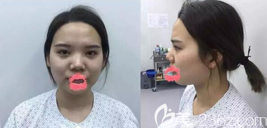 术前鼻子塌鼻头大,脸部凹陷法令纹深 术前鼻子塌鼻头大,脸部凹陷法令纹深