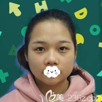 做综合隆鼻手术前的照片 做综合隆鼻手术前的照片