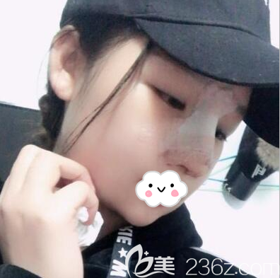 在内江达芬奇作为鼻综合术后即刻照片 在内江达芬奇作为鼻综合术后即刻照片