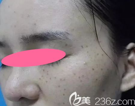 没去景德镇圣嘉丽整形做皮秒激光祛斑前的照片 没去景德镇圣嘉丽整形做皮秒激光祛斑前的照片