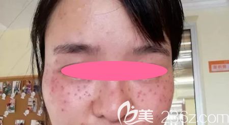 去景德镇圣嘉丽整形做皮秒激光祛斑治疗后即刻效果图 去景德镇圣嘉丽整形做皮秒激光祛斑治疗后即刻效果图