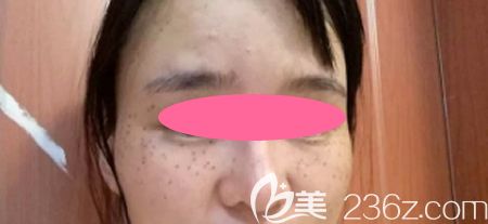 去景德镇圣嘉丽整形做皮秒激光祛斑治疗后第4天效果 去景德镇圣嘉丽整形做皮秒激光祛斑治疗后第4天效果