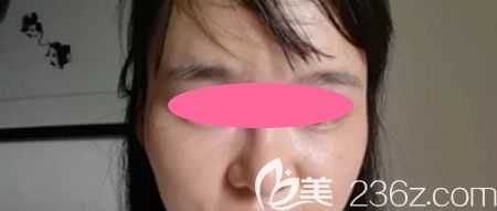 去景德镇圣嘉丽整形做皮秒激光祛斑治疗后第8天效果 去景德镇圣嘉丽整形做皮秒激光祛斑治疗后第8天效果