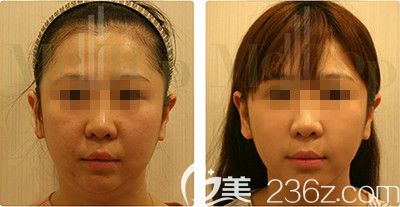 面部埋线提升案例 面部埋线提升案例
