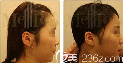 骨水泥后脑勺填充案例 骨水泥后脑勺填充案例