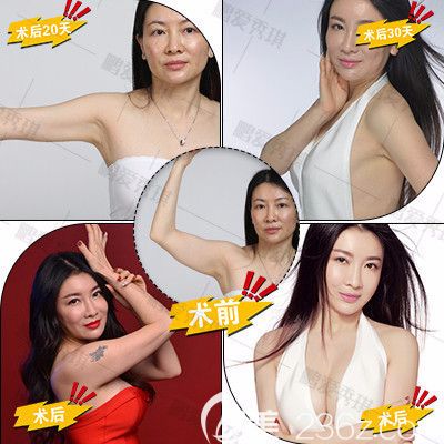 深圳鹏爱秀琪谭涛吸脂案例 深圳鹏爱秀琪谭涛吸脂案例
