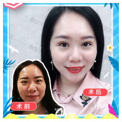 深圳鹏爱秀琪谭涛医生双眼皮案例 深圳鹏爱秀琪谭涛医生双眼皮案例