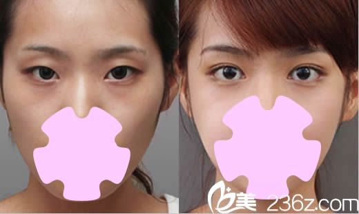 北京美莱整形双眼皮案例效果图 北京美莱整形双眼皮案例效果图