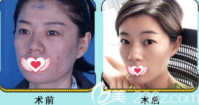 邯郸京美注射瘦脸案例