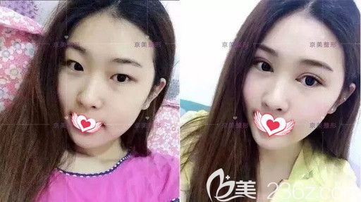 邯郸京美医疗美容5月整形优惠进行中 做双眼皮和注射瘦脸针都是680元