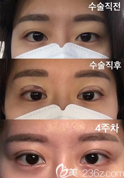 韩国1毫米整形外科都彦祿眼综合术前术后恢复过程图