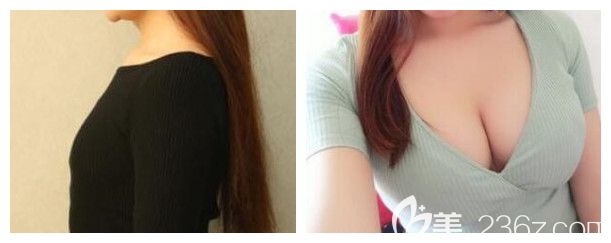 南宁梦想整形自体脂肪隆胸案例