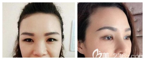 南宁梦想整形肋软骨鼻综合隆鼻案例