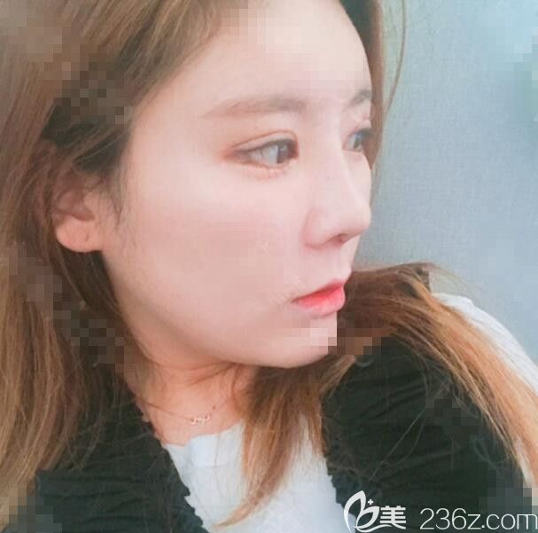 手术后一周 手术后一周